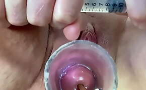 Extreme crying pain w inflation of catheter balloon in cervix