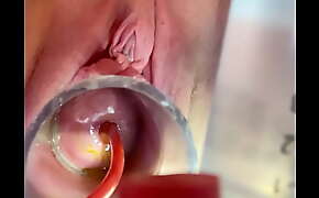 Crying w 4cc inflation of catheter balloon inside cervix